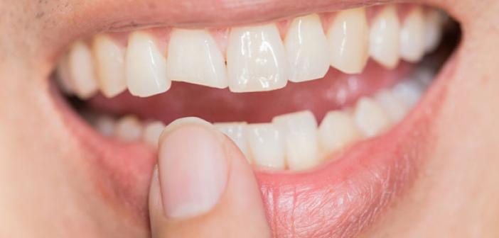 Rüyada Diş Kırılması ne demek? Rüyada Diş Kırıldığını Görmek ne anlama
