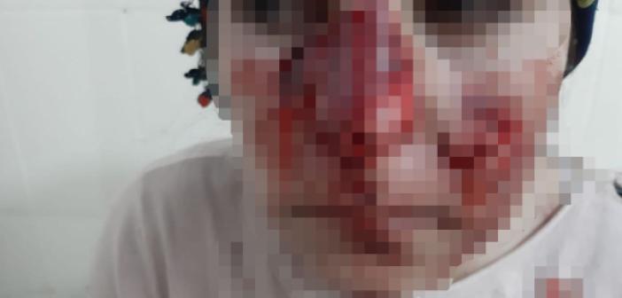 Mardin’de yine sokak köpeği vahşeti! yüzlerini parçalamış!