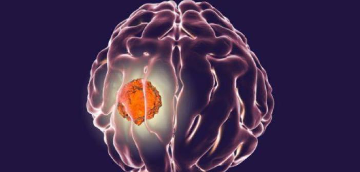 Beyin tümörü nedir, nasıl anlaşılır? Beyin tümörü belirtileri ve nedenleri