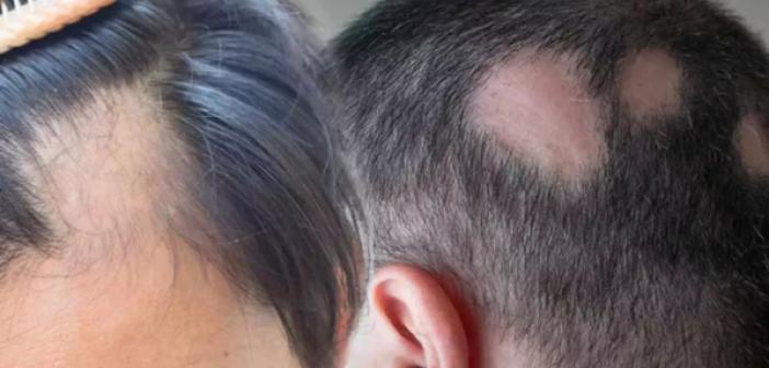 Saçkıran belirtileri ve tedavi yöntemleri nelerdir? Saçkıran hastalığı nedir? Tedavisi var mı?