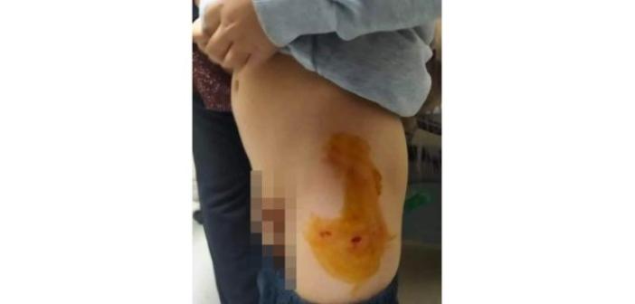 Mardin’de sokak köpeği 6 yaşındaki çocuğu ısırdı