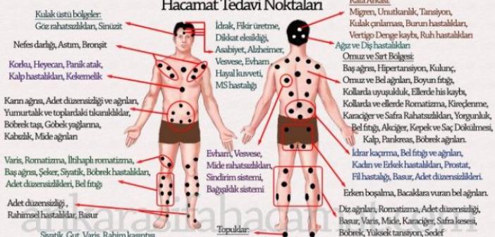 Hacamat (Kupa Uygulaması) Nedir? Hacamat Nasıl Yapılır? Hacamatın Faydaları Nelerdir? Hacamatın'ın yan etkileri