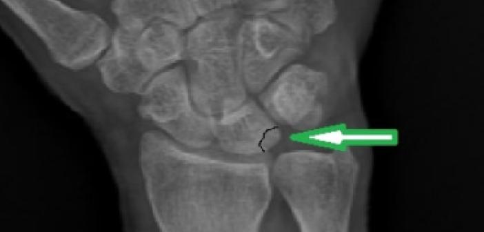 Navicular İmpaksiyon ne demek? Navicular İmpaksiyon Türkçe hastalık anlamı nedir?