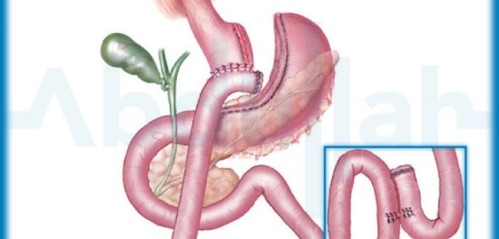 Gastrik Bypass Ameliyatı Hakkında Bilinmesi Gerekenler