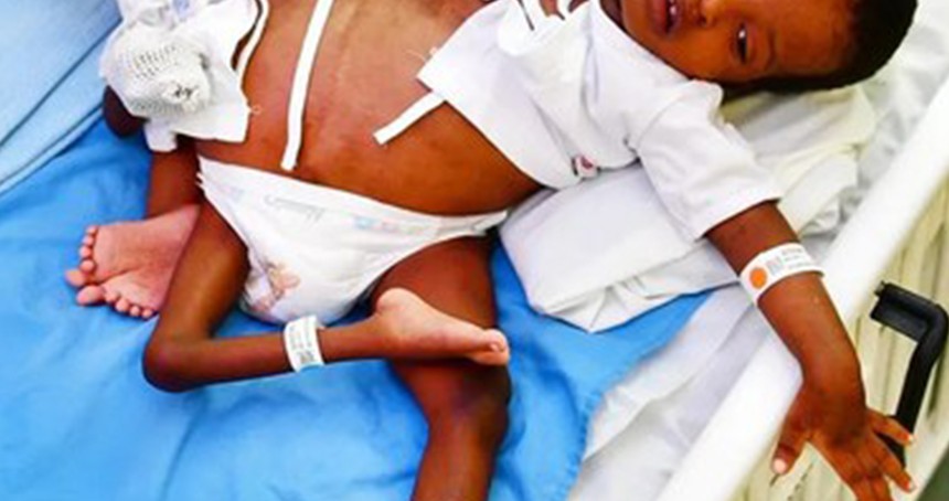 Tanzanyalı yapışık ikizler 16 saatlik ameliyatla ayrıldı
