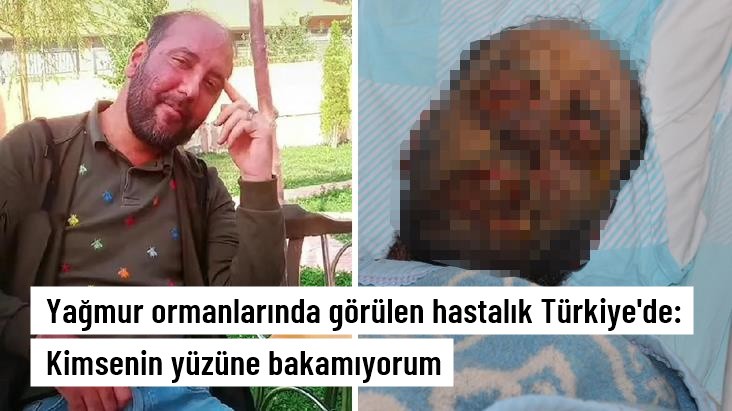 Korona geçirdi tanınmaz hale geldi 'Milyonda 2 kişide görülen hastalığa yakalandı'