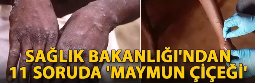 Sağlık Bakanlığı'ndan 11 soruda 'maymun çiçeği'
