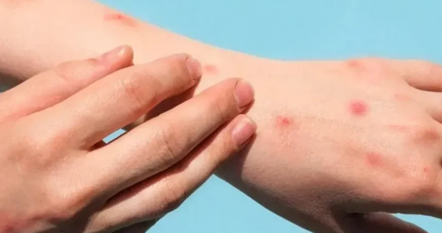 DSÖ'den maymun çiçeği uyarısı: Vakalar artmaya devam ediyor!