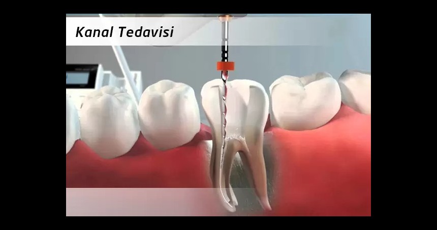 Kanal Tedavisi Nasıl Yapılır? Fiyatları ve Tedavi Süreci
