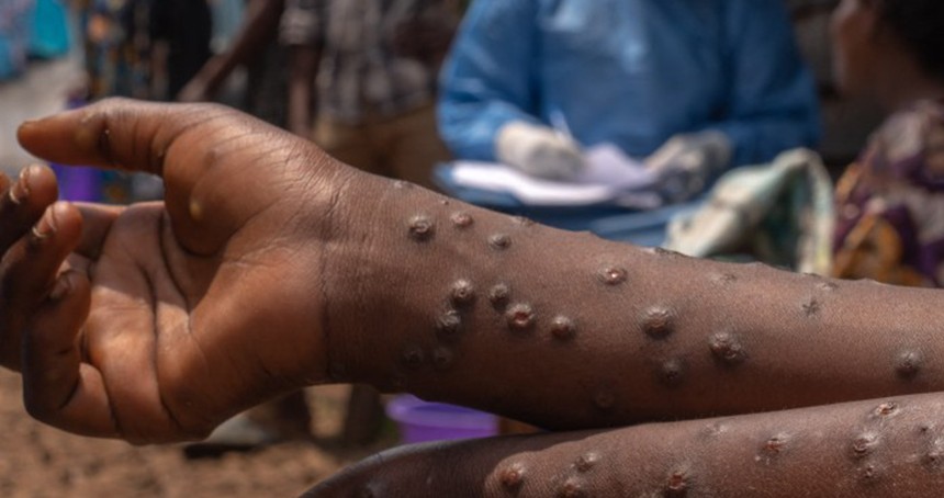 Uganda'da maymun çiçeği virüsü salgını: 37 ölü