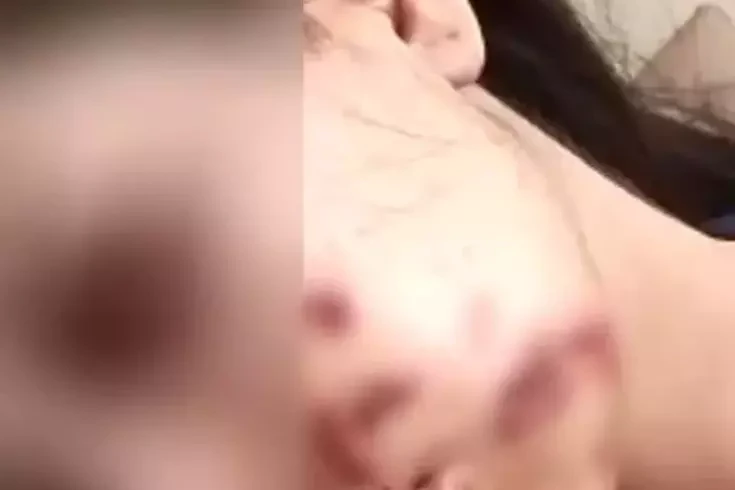 Gençlerin eğlencesi faciayla sonuçlandı: Yüzüne maytap isabet etti