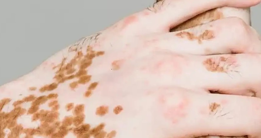 25 Haziran dünya vitiligo günü dolayısıyla farkındalık çağrısı