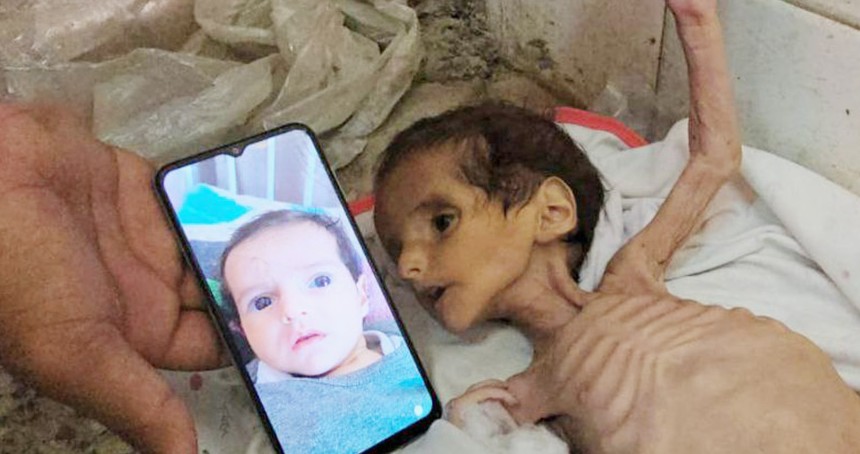 Gazze'de her gün 100'den fazla çocuk yetersiz beslenmeyle hastaneye yatırılıyor