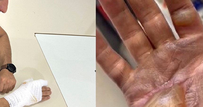 Telefon bataryası patladı tamirci yaralandı