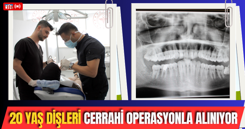 20 yaş dişleri cerrahi operasyonla alınıyor