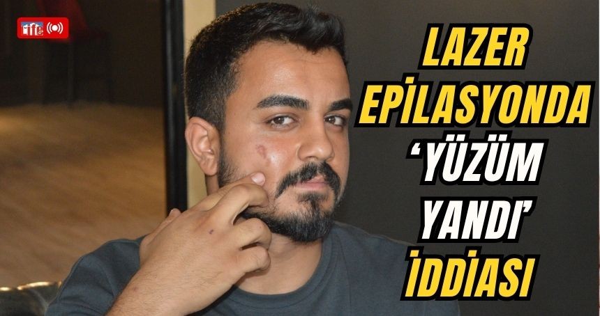Lazer epilasyonda ‘yüzüm yandı’ iddiası