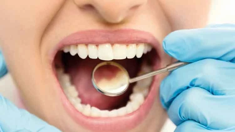 Dolgu tarihe karışıyor! Diş çürümesine yeni çare