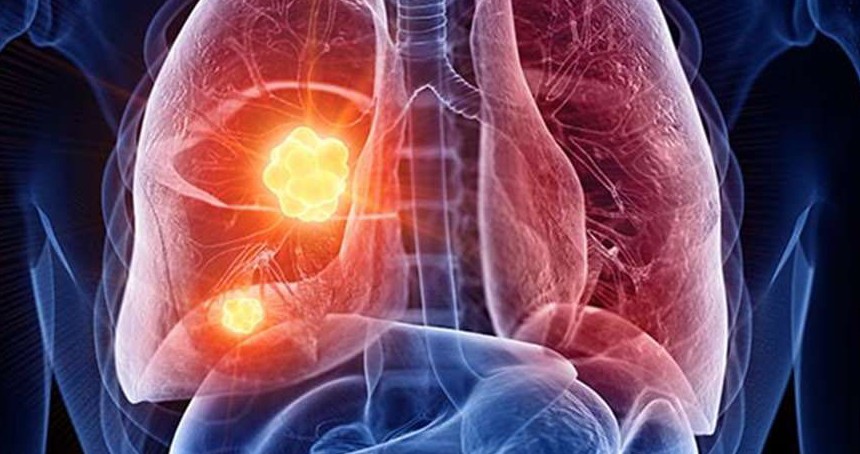 Akciğer kanseri riskini artıran faktörler