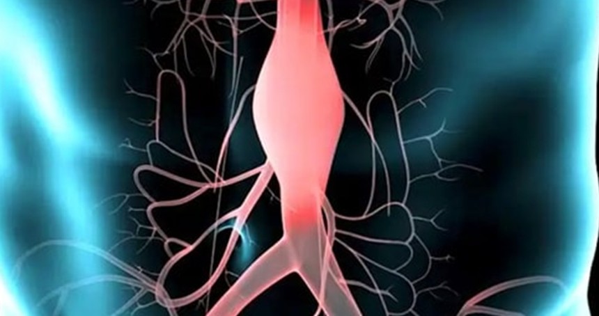 Sessiz ama tehlikeli bir hastalık: Aort anevrizması