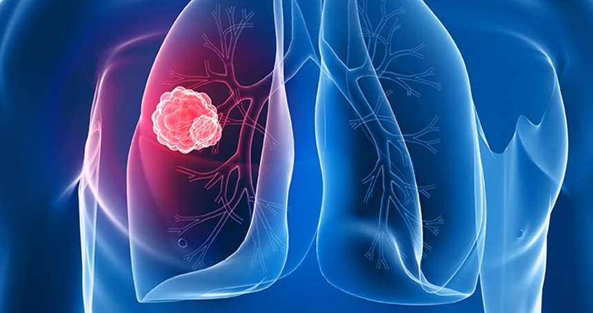 Göğüs Hast. Uzm. Dr. Tekeli: Kısa süreli kontroller akciğer kanserini erken teşhis ettiriyor