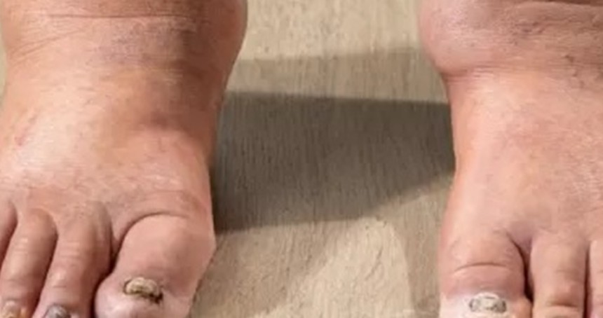 Kollarınızda veya bacaklarınızda şişlik varsa nedeni lenfödem olabilir!