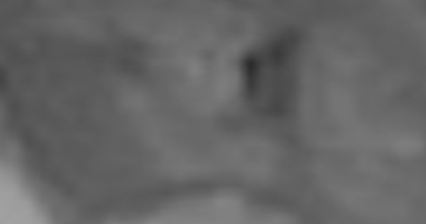 Laparoskopik Parsiyel Nefrektomi ile Ağrı'da bir ilk gerçekleştirildi!